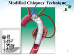 [EuroPCR 2011]降主动脉瘤在支架置入中的改良“烟囱技术”
