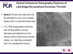 [EuroPCR 2011]晚期再通的冠状动脉血栓的OCT特征